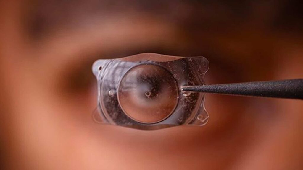 Implant intraoculaire - Lentille artificielle